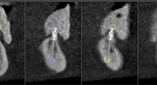 1,8 mm 2,1 mm 2,4 mm 2013 Ruusupora Kova luu: 1/2 implantin pituudesta Pehmeä luu: 1/3 implantin pituudesta 0 Suunnitelma 1 Limakalvon läpäisy 2 Ohjausporauksen syvyyden määritys Tapauskohtaisen