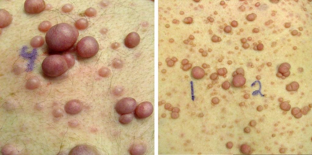 18 Review of literature border is well-defined and smooth. The size of macules increases with age proportionately to body growth, and the diameter can exceed 20 cm (De Schepper et al., 2006).