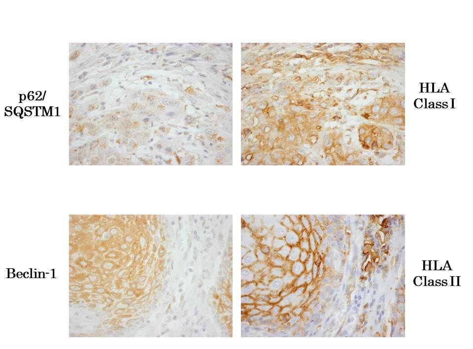 0084, ) IFN- microenvironment HLA autophagy p53 (Chikamatsu, 2009; Sakakura, 2007) p53 HLA-A2 A24 DP5 CD4+/CD8+T p53 ELISPOT (1) In vitro Gun-1, HSC-3 autophagy 2 western blotting autophagy LC3-II