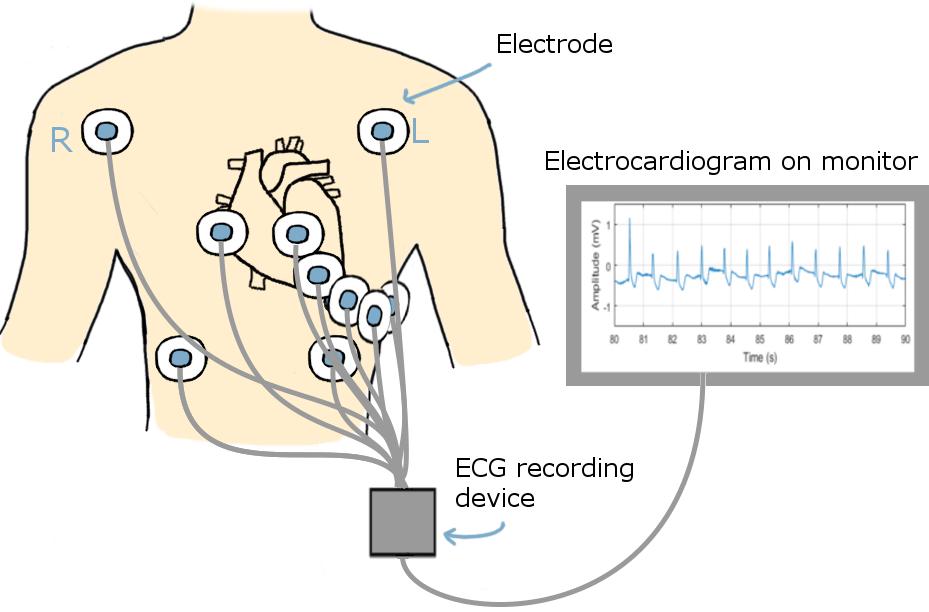 1 Introduction Electrocardiography (ECG) is a common noninvasive method in medicine used to monitor and diagnose patients (Neuman, 2009b).
