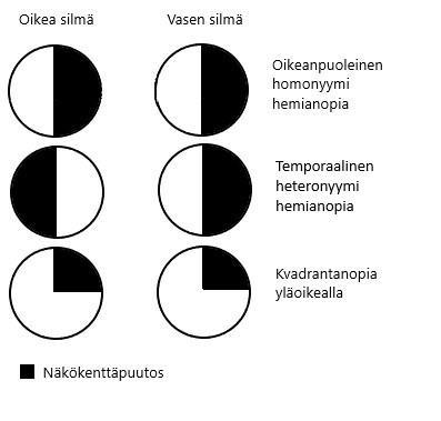 4 Homonyymisissä näkökenttäpuutoksissa hemianopia on samalla puolella näkökenttää kummassakin silmässä: joko oikealla tai vasemmalla puolella.