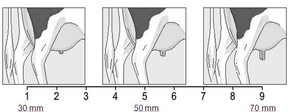 Vedinten pituus Epi (Teat length) Vedinten pituus arvioidaan etuvetimistä, vetimen tyvestä vetimen päähän.