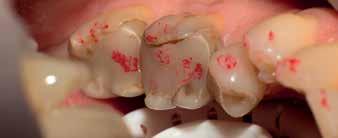 CEREC-käyttäjä CEREC mahdollistaa laajat koko leuan työt, esteettiset laminaatit ja nyt CEREC Ortho -lisäosan myötä myös kalvo-oikomisen ja metallirankaiset osaproteesit.