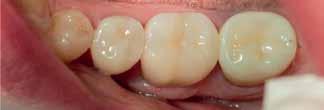 CEREC-jyrsimille Yhdistetty
