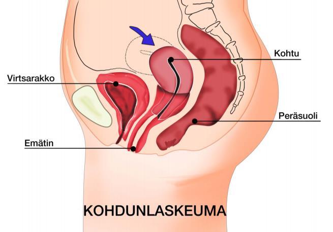 Laskeumat Emättimen etuseinämän