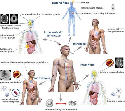 10 Figure 3. Complications after cell therapies for stroke (with permission from 141). 2.