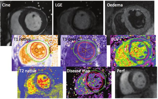 dissertationes scholae doctoralis ad sanitatem investigandam universitatis helsinkiensis 55/2018 PAULI PÖYHÖNEN Cardiovascular Magnetic Resonance Evaluation and Risk