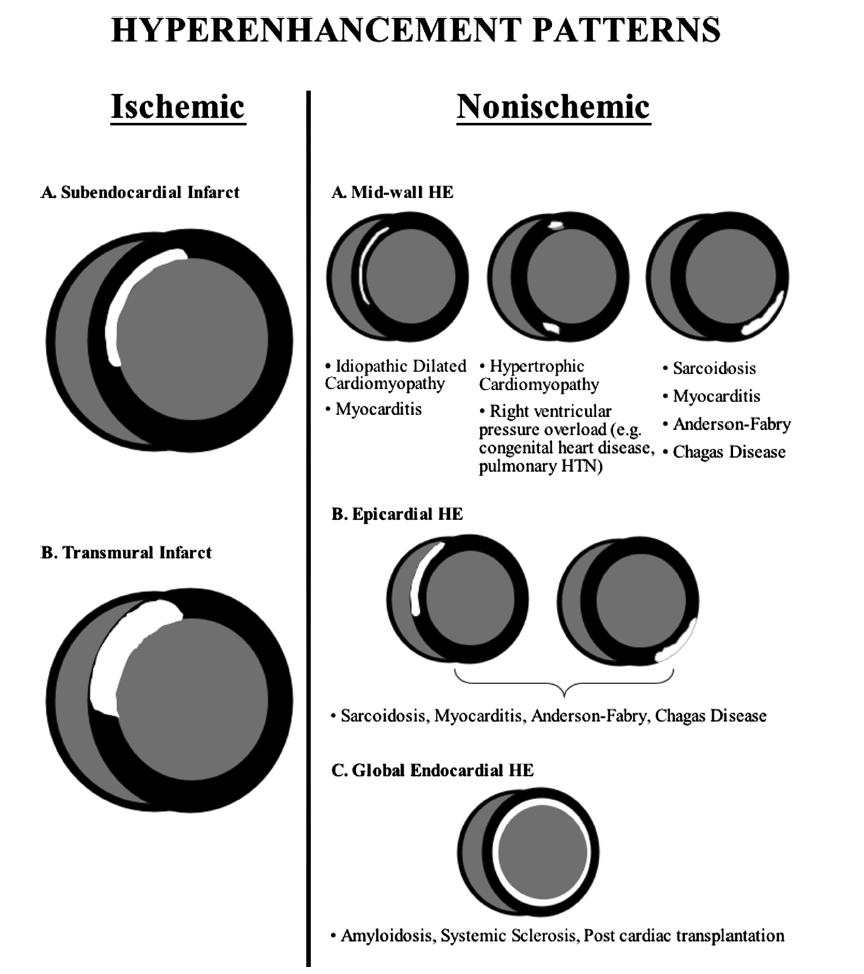 Review of the literature Figure 6. Typical late gadolinium enhancement (LGE) patterns in ischemic heart disease and non-ischemic cardiomyopathies.