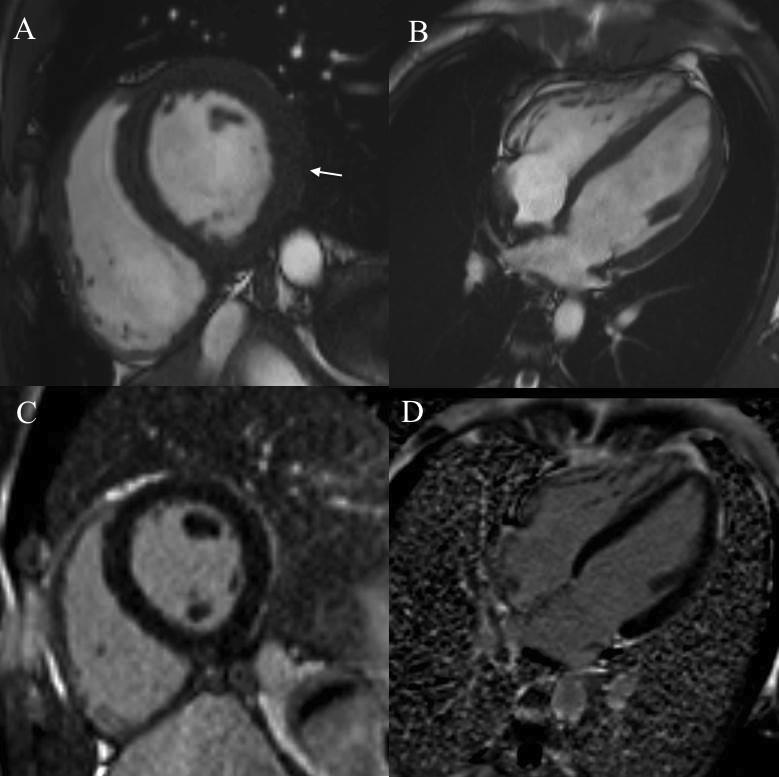 Results Figure 13. A 16-year-old male patient with a PRKAG2 mutation.