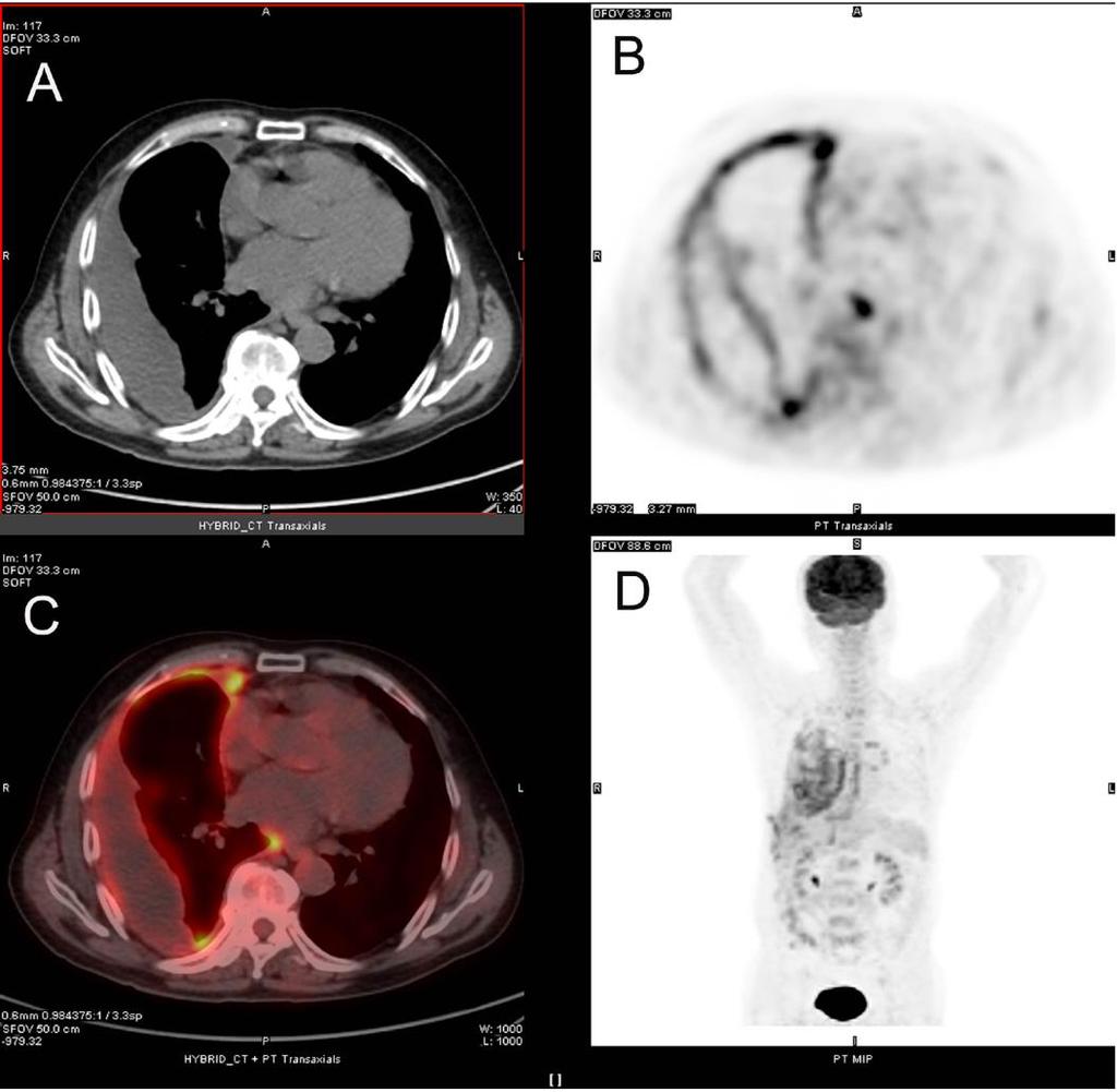 18 F-FDG PET/CT integrated imaging of 54- year old woman with left lung cancer and malignant pleural effusion 18F-FDG PET/CT integrated