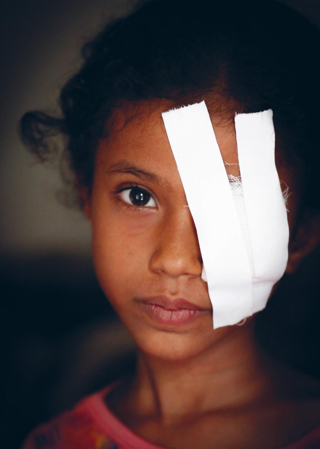 Jemen: Kahdeksanvuotiaan Razanin silmä vaurioitui vakavasti, kun häneen osui sirpaleita Hodeidahiin tehdyssä ilmaiskussa.