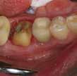 resiinisementti. Theracemia käytettäessä hammasta ei tarvitse erikseen esikäsitellä tai sidostaa.