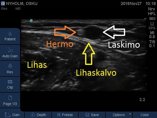 Hermovaurio Potilas ilmoittaa usein sähköiskumaisesta kivusta.