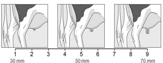 Vedinten pituus Epi (Teat length) Vedinten pituus arvioidaan etuvetimistä, vetimen tyvestä vetimen päähän.