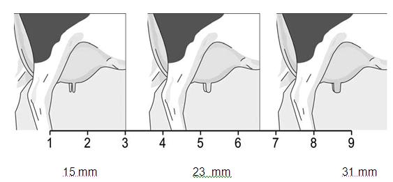 Vedinten paksuus Epa (Teat thickness) Vedinten paksuutta arvostellaan katsomalla etuvedinten leveyttä vedinten keskeltä (halkaisija, ei