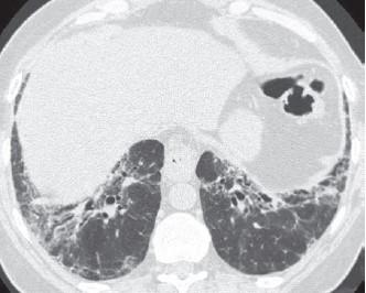 NSIP (Nonspesifc interstitial pneumonia Voi olla idiopaattinen Liittyy usein seuraaviin etiologioihin: Sidekudossairaudet Lääkeainereaktiot Hitaasti resorboituvat akuutit (DAD=diffuusi alveolivaurio)