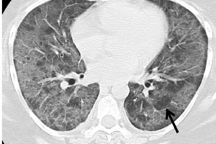 AIP:n radiologiset löydökset Diffuusit bilateraaliset mattalasivarjostumat ja konsolidaatiot, usein