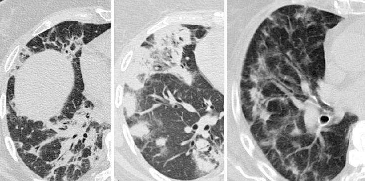 OP (organisoituva pneumonia) ja COP (kryptogeeninen organisoituva pneumonia) Organisoituva pneumonia on keuhkokudoksen korjausmekanismi, voi olla Kryptogeeninen Sekundaarinen keuhkovaurioille: