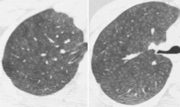 bronkioliitti) Lobulaarinen mosaiikkikuvioitus (pienten ilmateiden obstruktio) Ilmasalpaus