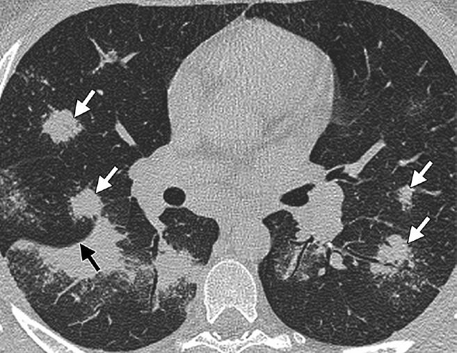 Sarkoidoosi -Epätyypilliset radiologiset löydökset Epäsymmetrinen adenopatia