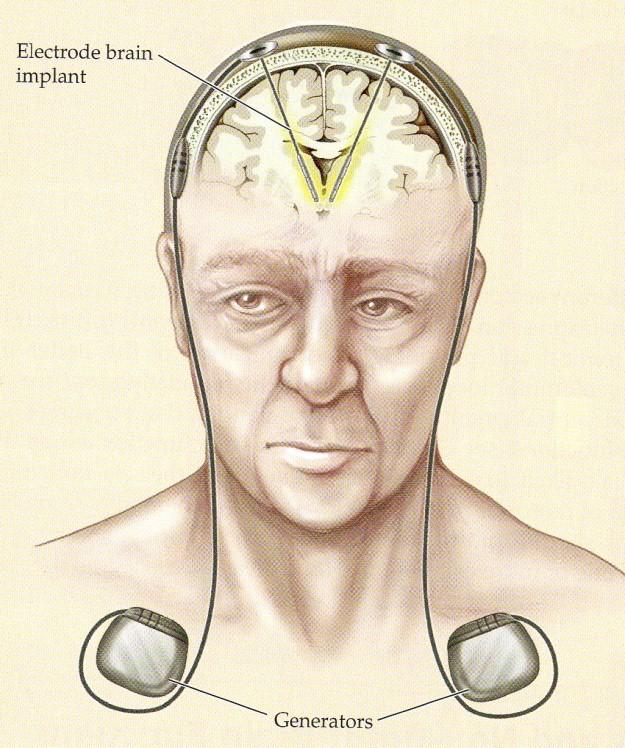 21 are transmitted to the target via the lead. The settings of the neurostimulator such as the number of electrodes and their combination, pulse width and amplitude etc. are all adjustable i.e. the stimulation can be tailored to meet the individual needs of each patient.