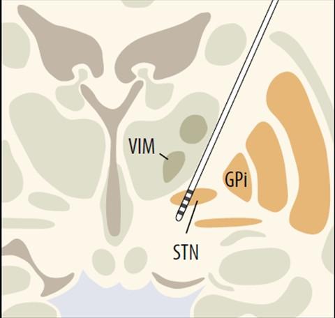 22 The most common target nucleus in treatment of PD is the subthalamic nucleus (STN) as seen in Figure 14. Other option is the globus pallidus interna (GPi).