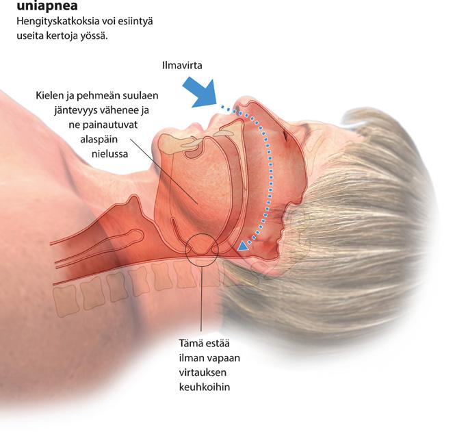 Ilmavirta Normaali Hengitys on vapaata ja esteetöntä. 2. Syyt uniapnean taustalla Merkittävin uniapneaa aiheuttava tekijä on ylipaino. Uniapneaa sairastavista 50 70 prosenttia ovat ylipainoisia.
