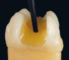 flow-muovi dentiinin korvaamiseen. Syviin ja laajoihin kaviteetteihin sekä pilarin rakentamiseen.