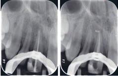 Ne ovat tuoneet endodonttiseen kirurgiaan tiiviin retrogradisen täytteen ja mahdollistaneet kavumin pohjan ja juurikanavan seinämän perforaatioiden tiiviin sulkemisen.