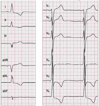 16 The cornerstone of the treatment of LVH associated with hypertensive heart disease is effective, long-term antihypertensive therapy.