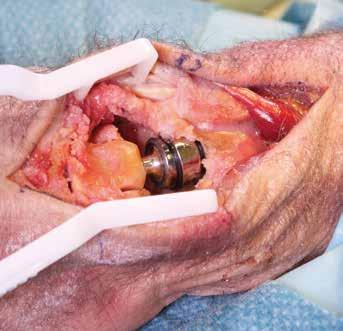 Metacarpal Head -osa luksoituu Radius Cup -osasta.