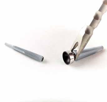 Aseta Cup Remover -työkalun kärjet Radius Threaded Implant -osan ja Radius Cup -osan väliin.