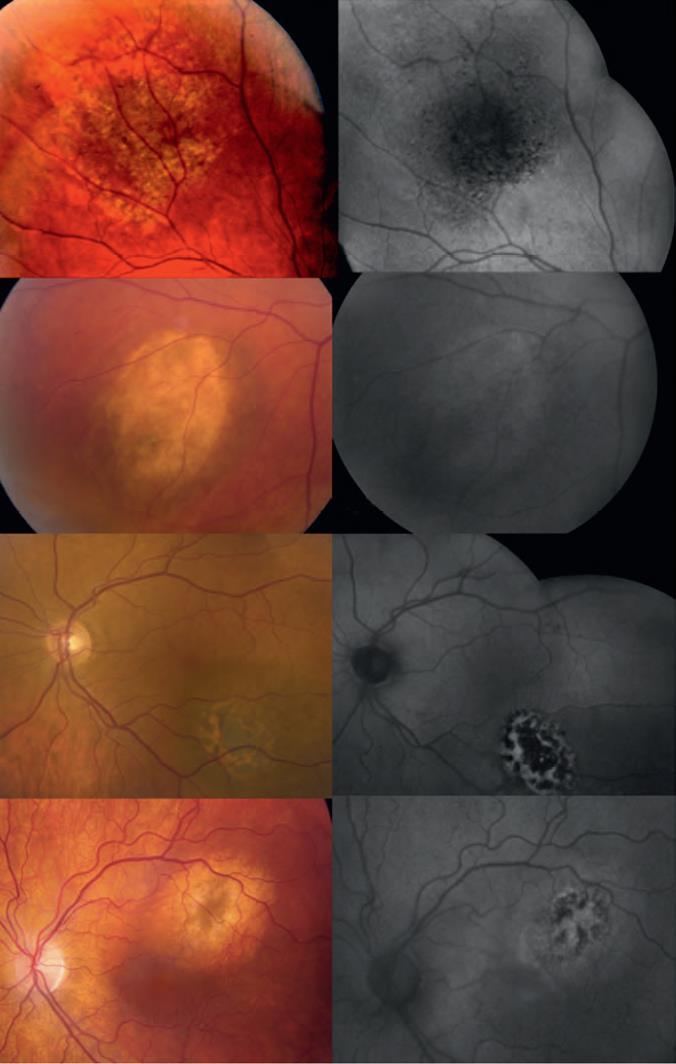 Melanosyyttiset tuumorit A: suonikalvon pigmenttineevus Pigmentoitunut alue hypoautofluoresoiva samoin kuin päällä oleva RPE, drusenit lievästi hyperfluoresoivia B: Apigmentoitunut neevus Halo