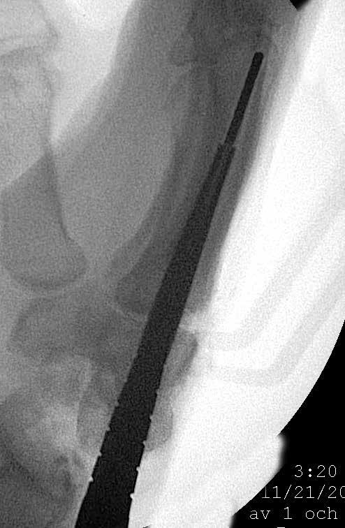 Poraussyvyys voidaan nähdä suoraan Cannulated Metacarpal Drill -poranterän leikkausurista.