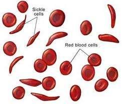 SIRPPISOLUTAUTI Geneettisesti peritty hemoglobinopatia (HbSS) peittyvästi periytyvä Alkaa oireilla vasta 1-3-vuotiaana,