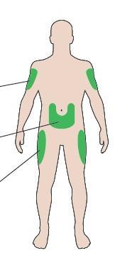 Injektionsställen Överarmen Buken Låren Lär känna din penna Insulinbehållare Kolvstång* Doseringsfönster Dospekare Skyddslock Gummiförsegling Insulinskala Insulinets namn Dosväljare Injektionsknapp *
