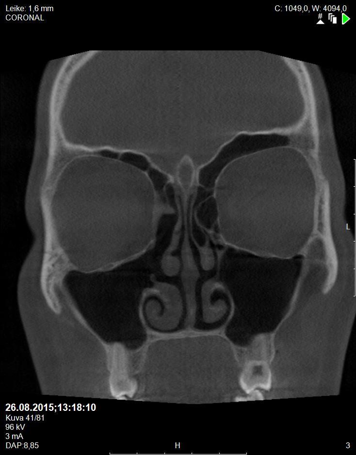 MRI Post-op.