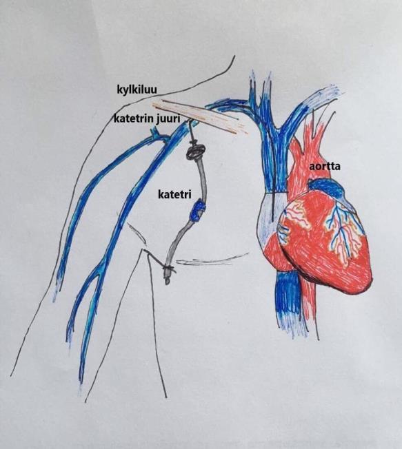 katetrin erillisiin kanaviin (Kuva 3). Moniluumenkatetri mahdollistaa lääkeaineiden ja infuusioliuosten samanaikaisen antamisen.