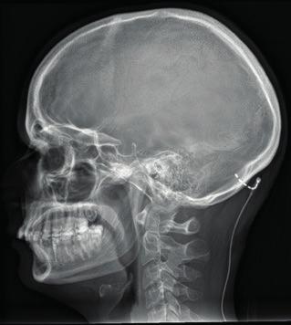 (6) raportoivat 1990-luvun alkupuolella servikogeenisen päänsäryn hoidosta ison okkipitaalihermon (nervus occipitalis major) neurolyysillä.