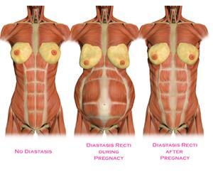 9 3 Suorien vatsalihasten erkaantuma Kuva 1: Suorien vatsalihasten erkaantuma anatomisesti (https://www.momsintofitness.