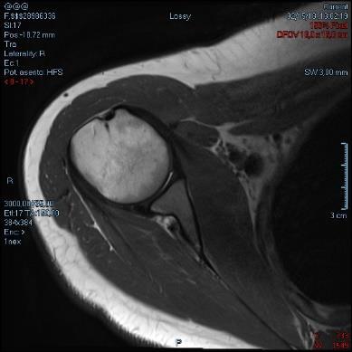 17 3.2.2 Magneettikuvaussekvenssit Koska olkapään luusto ja lihakset sijoittuvat anatomisiin tasoihin verrattuna viistosti, myös koronaali- ja sagittaalisuunnan kuvasarjat ovat viistoja.
