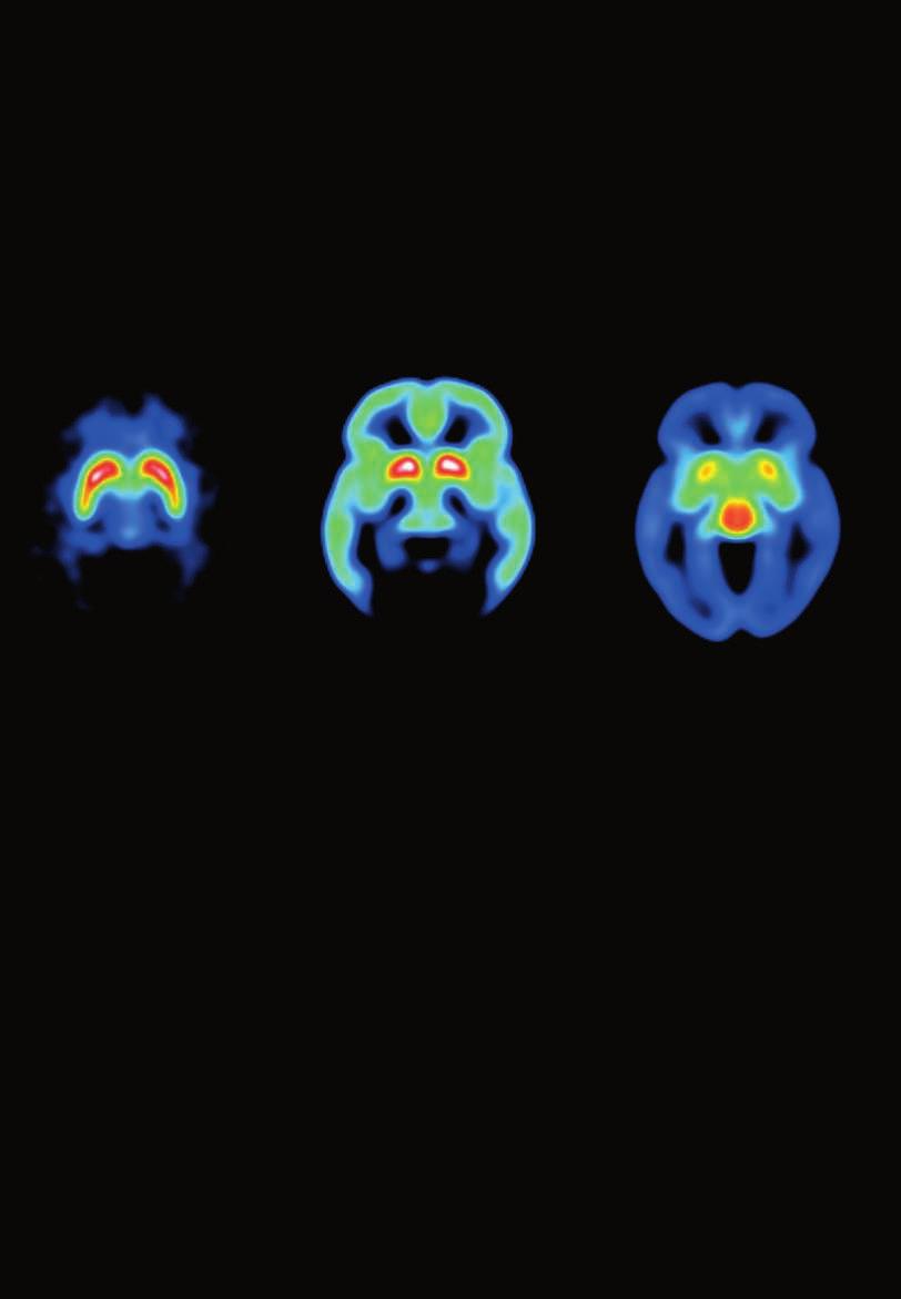DOPAMINE, OPIOID AND SEROTONIN NEUROTRANSMISSION IN BEHAVIORAL ADDICTIONS Joonas Majuri TURUN YLIOPISTON