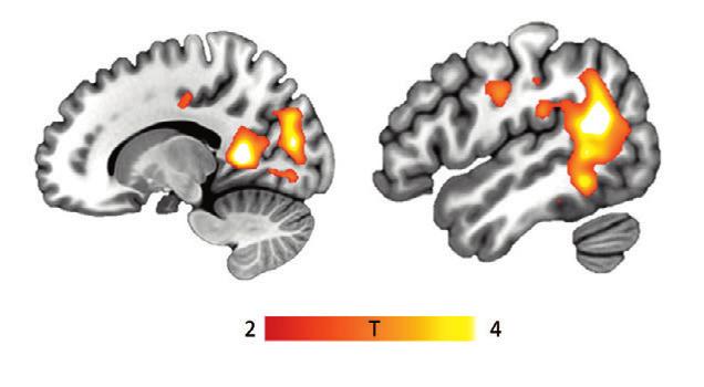 Results 47 in the inferior temporal gyrus and lateral orbitofrontal cortex in the post hoc comparisons of the PG and BED patients but was not evident in the nucleus accumbens (Table 5).