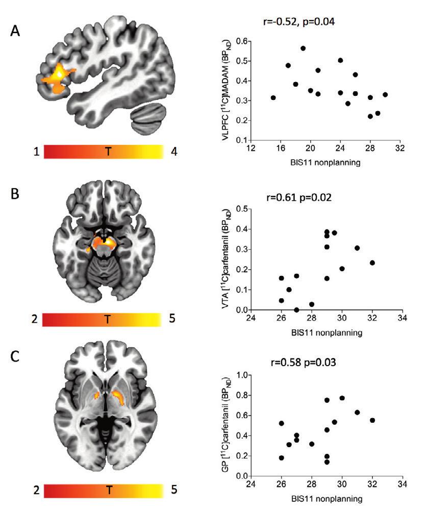 Results 53 Figure 8: Correlations between non-planning impulsivity and tracer uptake.