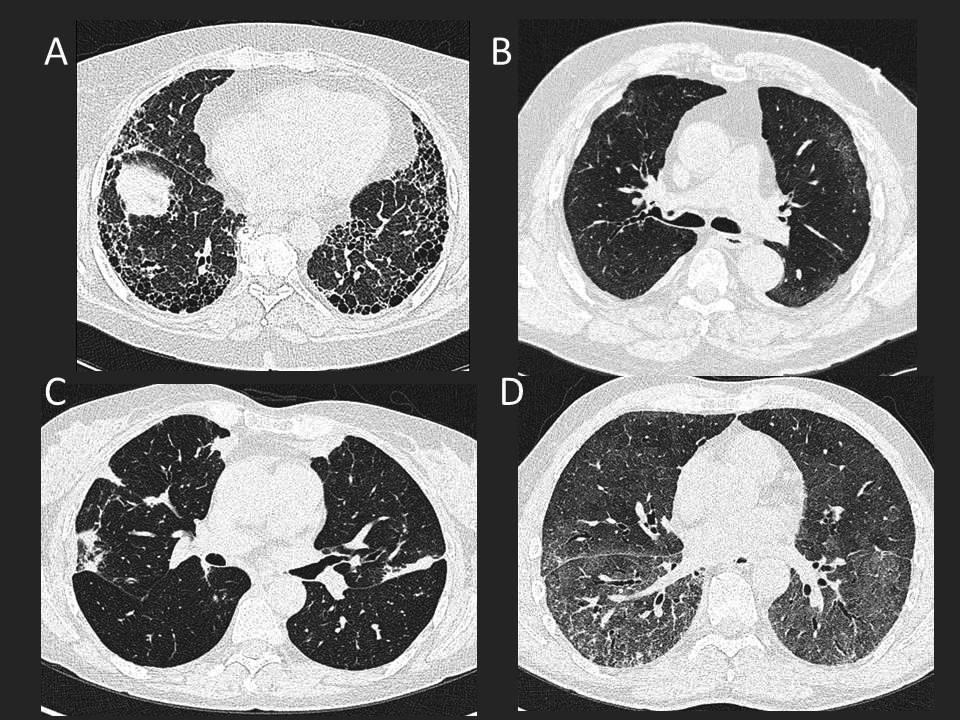 18 Figure 4. Representative high-resolution computed tomography (HRCT) images from the subjects with rheumatoid arthritis- associated interstitial lung disease.