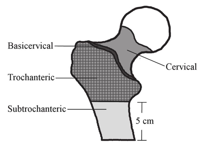 2 Review of literature This thesis focuses on hip fracture patients age 50 years or older. Hip fractures in this age group are often caused by low-energy trauma, usually by falling.