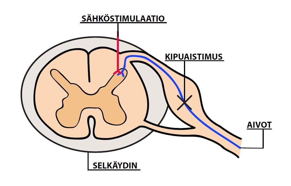 9 kipuastimuksen kulun katkeaminen neurostimulaation avulla. (Arstila, Björkqvist, Hänninen & Niensted 2014, 483 485; Hagelberg ym. 2006, 33-52; Vainio 2009, 12-14.) Kuva 1.