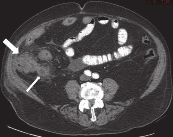 Review of literature 33 Figure 3 CT images of two appendiceal tumor patients with acute appendicitis.