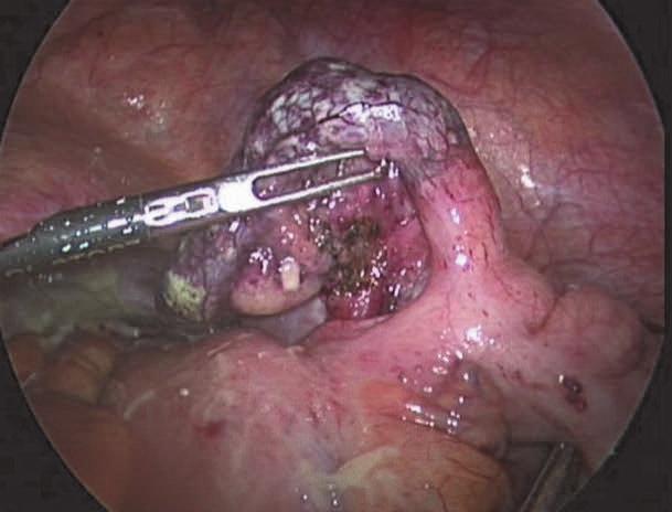 The recognized disadvantages of the laparoscopic approach as compared to the open technique are its procedural length, the rate of intra-abdominal abscesses and costs.