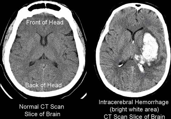 14 KUVA 2. Vasemmanpuoleisessa CT-kuvassa aivojen normaali tila ja aivojen sisäinen verenvuoto (ICH) oikeanpuoleisessa CT-kuvassa (UW Medicine N.d.a) 3.1.4 Verenvuoto aivokalvon alle Subaraknoidaalivuoto eli SAV on lukinkalvonalainen verenvuoto, eli verta vuotaa aivokalvon alaiseen tilaan.
